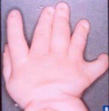 Hand of a patient (different patient than in the i