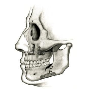 Maxillary-mandibular advancement in obstructive sl