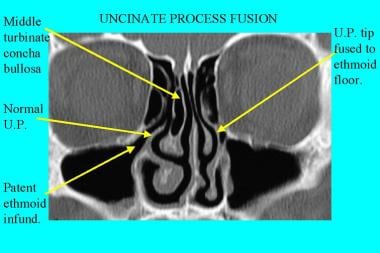 CT scan, nasal cavity. Fusion (apparent) of uncina