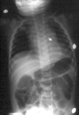 Pediatric Thoracic Trauma. Posteroanterior chest r