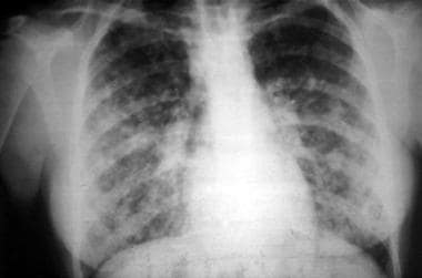 Acute pulmonary syndrome in a 16-year-old female a