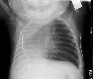 A posteroanterior radiograph of a 3-month-old infa