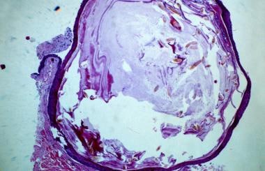 Histopathology of an eruptive vellus hair cyst sho