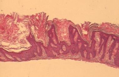 seborrheic keratosis histology