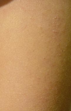 Keratosis pilaris on the upper arm of a twin femal