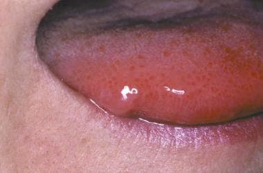 Close-up view of contact urticaria of the tongue i