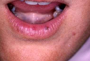 Intramucosal nevus on the lower lip. This brown pa