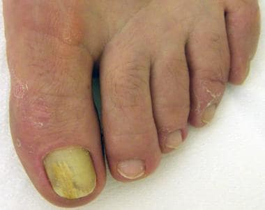 Before and after Successful Treatment for a Onychomycosis or Fungal Nail  Infection on Damaged Nails after Gel Polish Stock Photo - Image of disease,  medical: 216597144