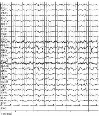 Focal status epilepticus. Electroencephalograph (E