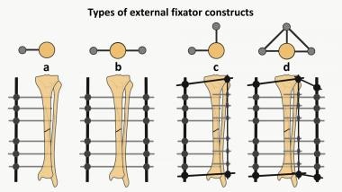 Types of frame constructs used for external fixati