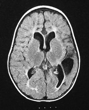 Magnetic resonance image (MRI) of a 16-month-old b
