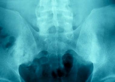 Bilateral sacroiliac joint fusion in a patient wit
