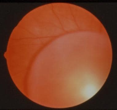 Ectopia lentis. Dislocated lens into the vitreous 