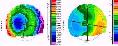 LASIK for Correction of Astigmatism Treatment & Management: Surgical ...