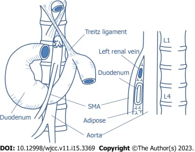 Superior Mesenteric Artery SMA Syndrome Practice Essentials Superior Mesenteric Artery SMA Syndrome Practice Essentials