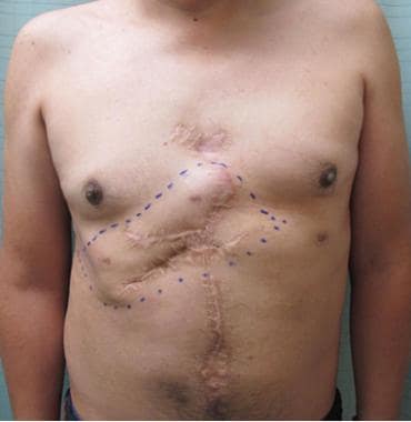 Forty-six-year-old patient with chest wall recurre