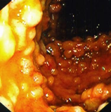 Endoscopic images showing multiple large intestina