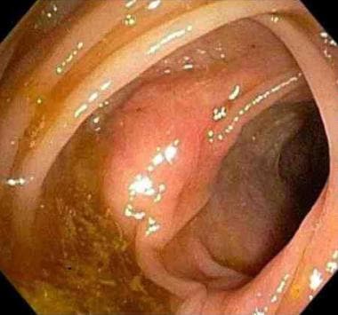 Endoscopic view of a sessile polyp. 