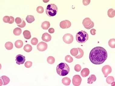 megaloblastic anemia peripheral smear