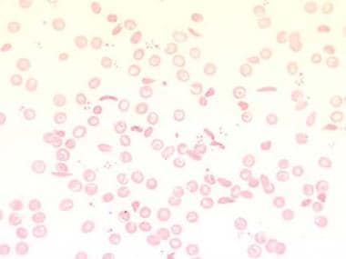 hemoglobin sc disease blood smear