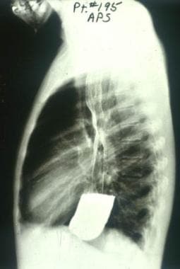 Barium swallow radiographic study of a Brazilian p