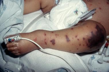 The leg of a 9-month-old infant in septic shock wi
