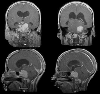 Multiple skull base meningiomas. Contrast-enhanced