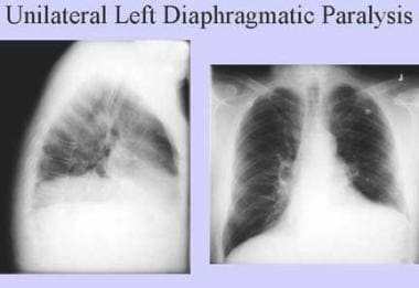 急性单侧左侧横膈膜麻痹