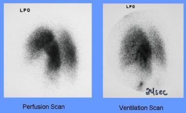 A segmental ventilation perfusion mismatch is evid