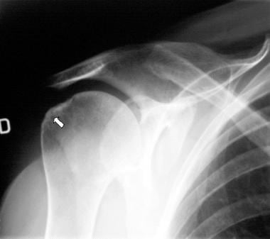 Subchondral sclerosis of the humeral head as seen 