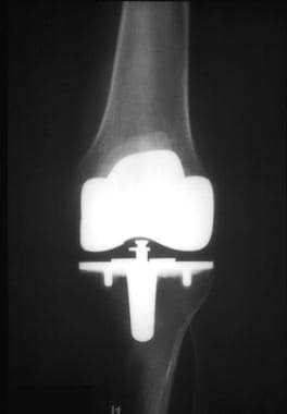 Anteroposterior radiograph obtained after knee rep