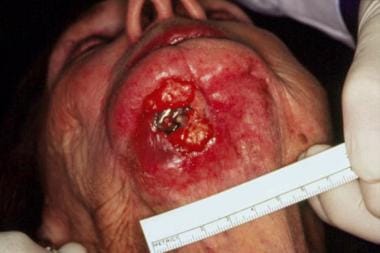 Squamous cell carcinoma causing an oral cutaneous 