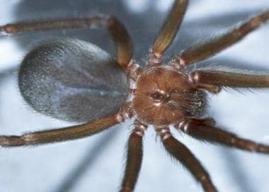 Spider envenomations, brown recluse. Close-up imag