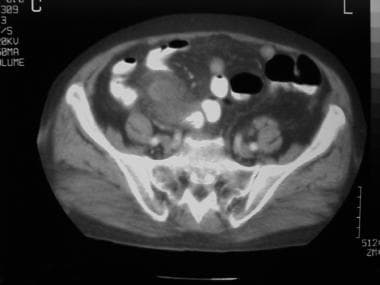 Inflammatory mass in the right lower quadrant of a