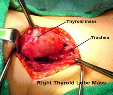 Standard open thyroidectomy. 