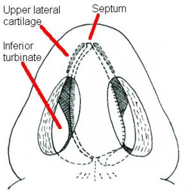 Rhinoplasty for internal valve stenosis. Internal 