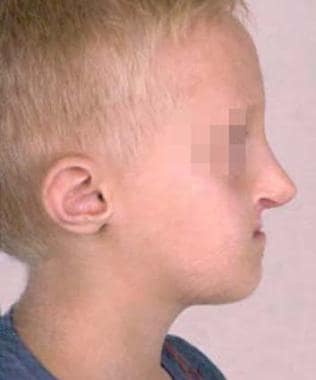 Young boy (same patient as in the image above) wit