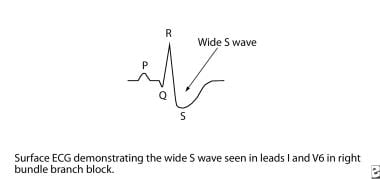 This image demonstrates a wide S wave. 