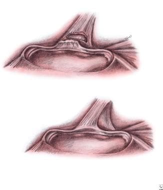 
Upper left - Type III superior labrum anterior po