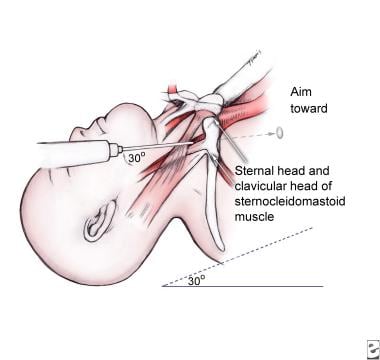 Internal jugular vein, central approach. 