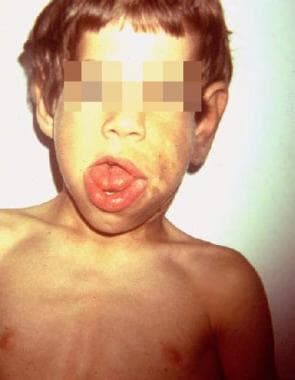 Macroglossia and hemifacial overgrowth associated 