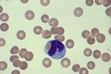 Blood smear showing spherocytosis, polychromatophi