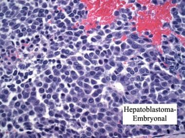 Embryonal hepatoblastoma. Hematoxylin and eosin st