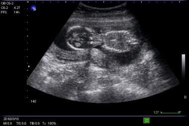 Transverse picture of intrauterine pregnancy. 