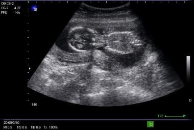 ruptured ectopic pregnancy ultrasound