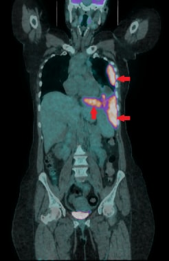 This coronal 18F-FDG PET/CT demonstrates a markedl