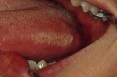 hairy tongue from chewing tobacco