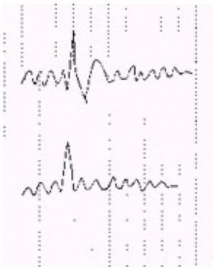 Schematic of an interictal epileptiform discharge 