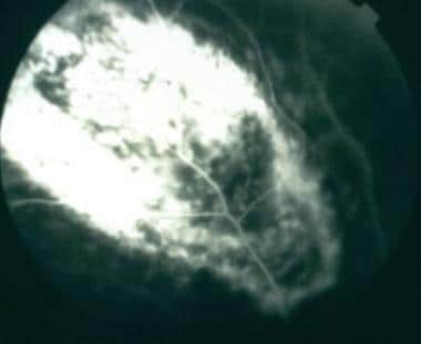Late fluorescein angiogram of choroidal melanoma s