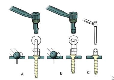 The application of the drill guides depends on the